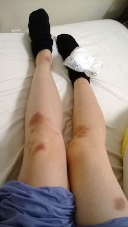 Legs with bruises